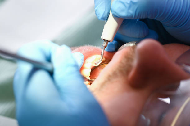 Best Emergency Root Canal Treatment in Nash, TX