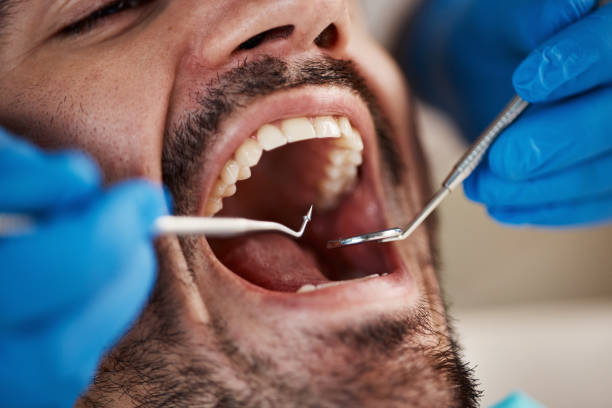 Best Emergency Tooth Extraction in Nash, TX